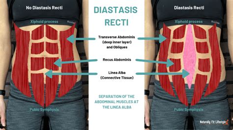 What is Diastasis Recti Repair?